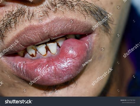 Mucous Cyst Mucocele Lower Lip Southeast стоковая фотография