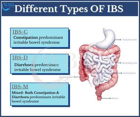 How To Manage Irritable Bowel Syndrome Ibs Naturally Wellness By Rosh Integrative Wellness