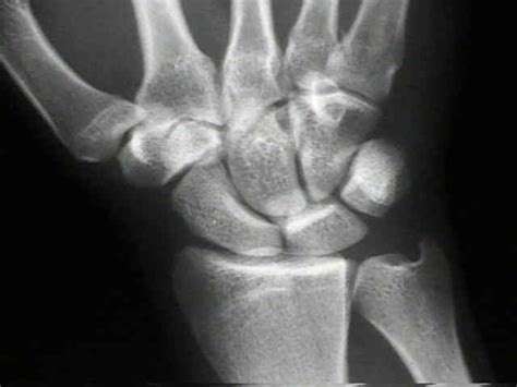 Scaphoid Fracture Signs Of A Broken Wrist Bone