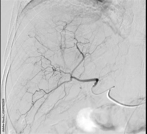 Imaging Of Tace Or Chemoembolization Is A Procedure That Allows A Dose