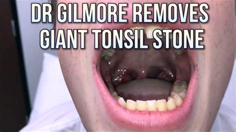 Tonsil Stones Symptoms