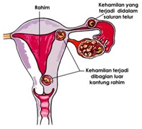 Tetapi terdapat beberapa faktor yang meningkatkan risiko untuk seseorang mengalami masalah ini. Kehamilan Ektopik - Hamil.co.id