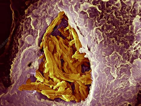 Tb is a serious infection that affects the lungs and sometimes other parts of the body, such as the bones, joints and kidneys. Macrophage engulfing tuberculosis vaccine - Stock Image ...