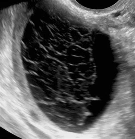 Hemorrhagic Cyst Ultrasound Image Of A Hemorrhagic Cyst Shows