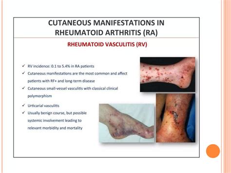 Cutaneous Manifestations Of Rheumatoid Arthritis Ppt