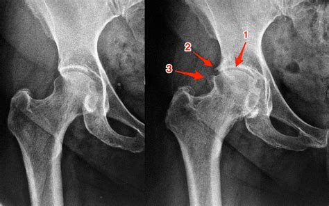 Osteoartrose Do Quadril — Dr David Gusmão Ortopedista Da Sociedade