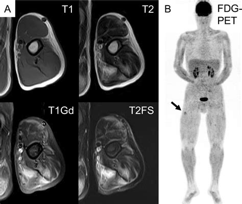 Figure 1 From Extranodal Nkt Cell Lymphoma Mimicking Granulomatous