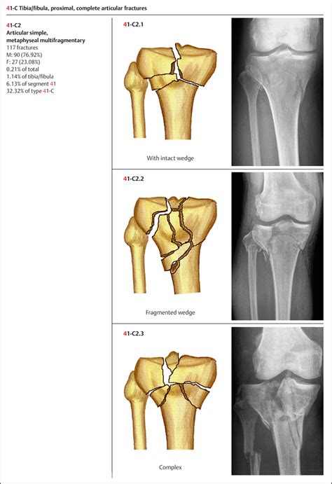 Fractures Of The Tibia Fibula Musculoskeletal Key Free Nude Porn Photos