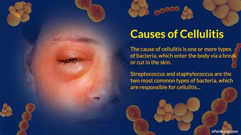 Cellulitis is a bacterial infection of the skin and soft tissues that causes swelling, redness, tenderness, and warmth. Cellulitis (Infections) - Apex Dermatology & Skin Surgery
