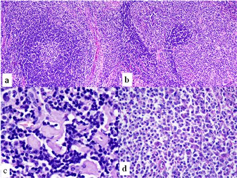 Spectrum Of Morphological Changes In Lymph Nodes Of Hiv Infected