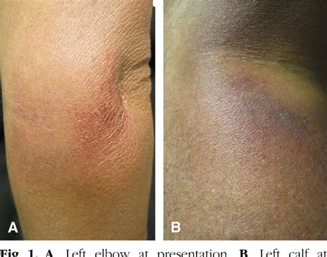 Figure 1 From Recurrence Of Nevus Depigmentosus After An Autologous