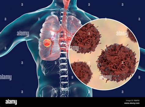 Lungenkrebs Computer Zeigt Einen Cancerous Tumor In Der Lunge Und Eine