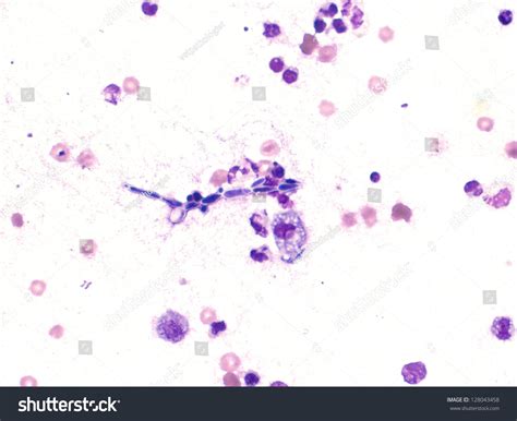 Cytology Smear Pleural Effusion Showing Candida Stok Fotoğrafı Şimdi