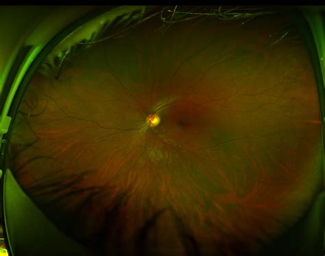 Optomap Wide Field Retinal Image That I Took Myself Of My Os Optometry