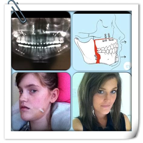 A Guide To Surviving Orthognathic Surgery Before And After Jaw Surgery