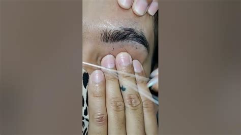 Satisfying Blackhead Relaxing And Pimple Popping Relaxing Acne Pimple