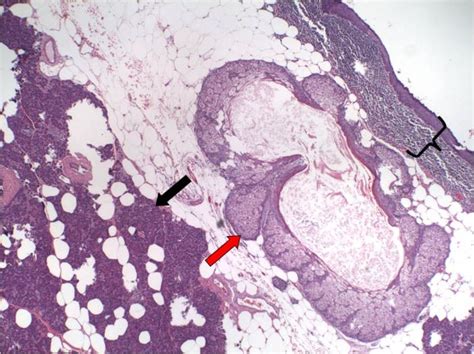 63 Year Old Male With A Dermoid Cyst Of The Pancreas Microscopic