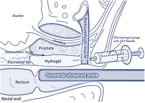 Optimization Of Prostate Brachytherapy Techniques With Polyethylene Glycolbased Hydrogel