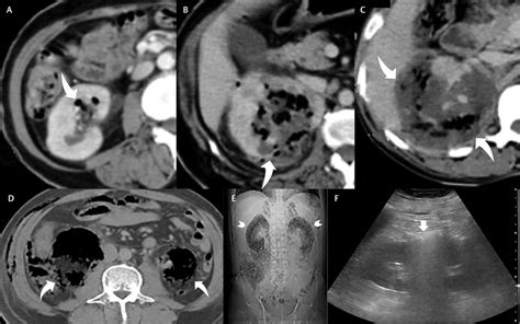 A Axial Computed Tomography Ct In The Nephrogram Phase Shows Class