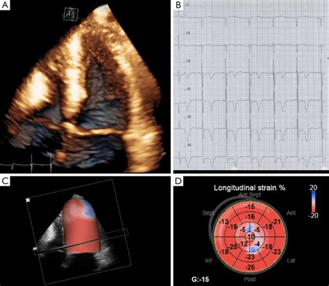Apical Hypertrophic Cardiomyopathy Shown By 3D Rendering A With The