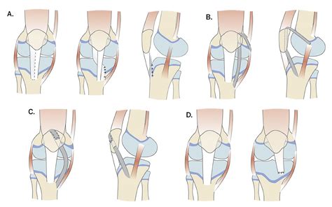 Patellar Instability Knee And Sports Orthobullets