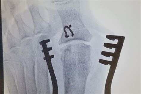 3 Cartiva Big Toe Joint Partial Replacement X Ray After Foot And Podiatry Surgery