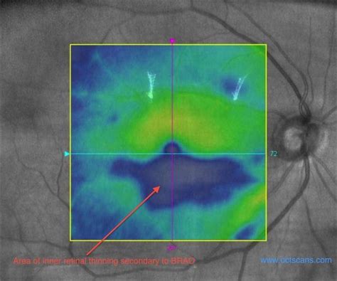 Retinal Artery Occlusion Optical Coherence Tomography Scans
