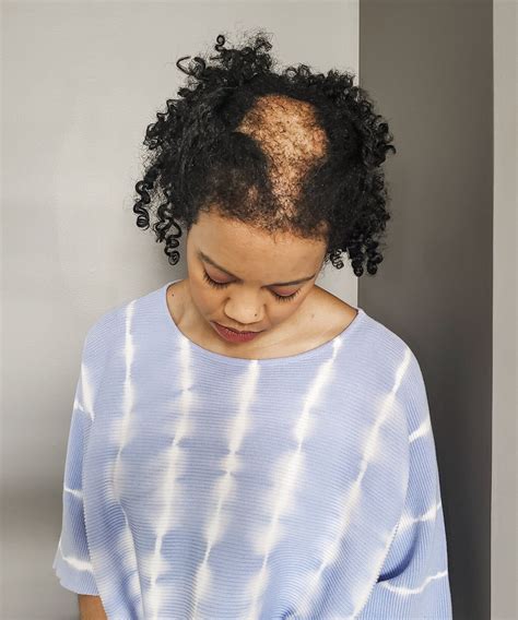 Scarring Alopecia And Chronic Hair Loss Is Prevalent Amongst Black Women