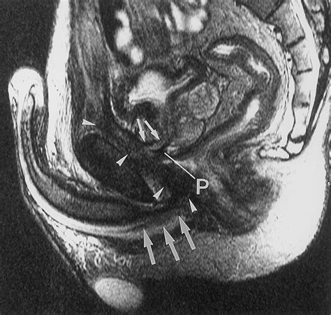 Mr Imaging Of The Male And Female Urethra Radiographics