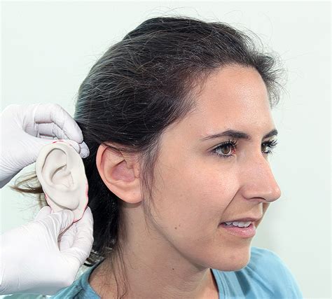 Prosthetic Ear Ear Prosthesis Microtia Wisconsin — Life Like