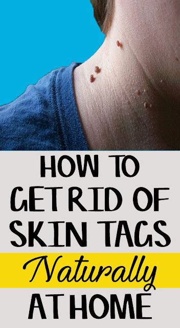 best remedies to get rid of skin tags naturally