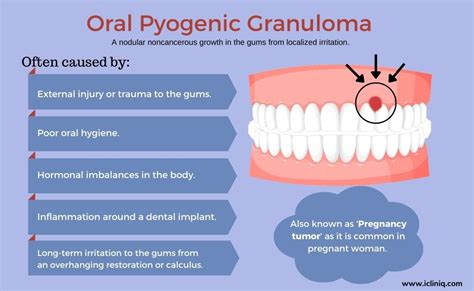 Oral Pyogenic Granuloma Causes Diagnosis Treatment Prevention