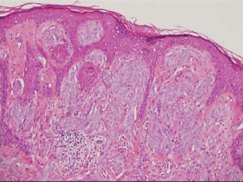 Histologic Mimics Of Malignant Melanoma Smj