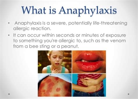 Anaphylaxis Management Of Anaphylaxis Australian Medication Safety