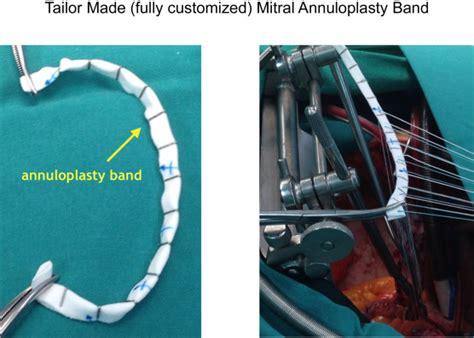 Tailor Made Mitral Annuloplasty Band Used At St Lukes Hospital Is