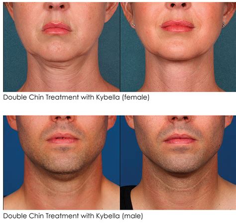 Kybella Before And After Robinson Fps