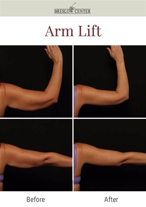 Achieve Beautiful Arms With Arm Lift Surgery