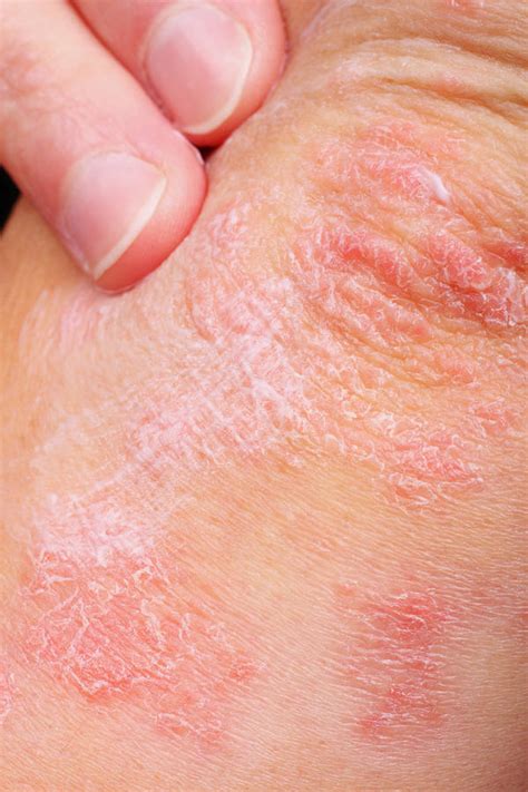 Types Of Skin Diseases Answers To All Types Of Questions