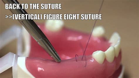 Back To The Suture 2 Vertical Figure Eight Suture Youtube