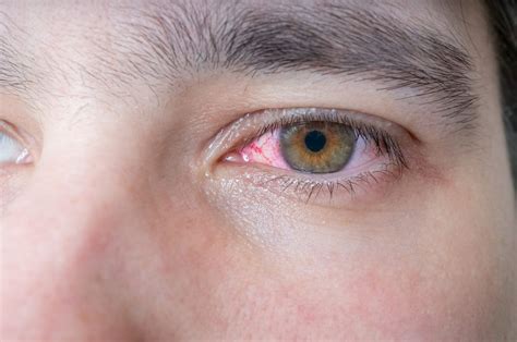 Pink Eye Symtoms Diagnosis Treatment