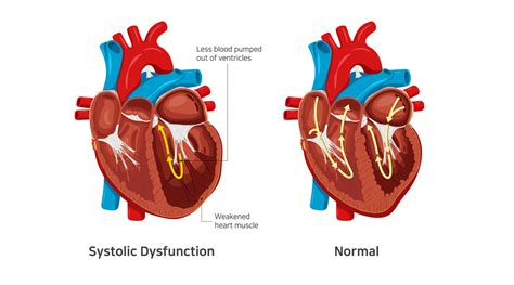 What Ar Systolic Heart Failure Symptoms And Treatment Dr Raghu