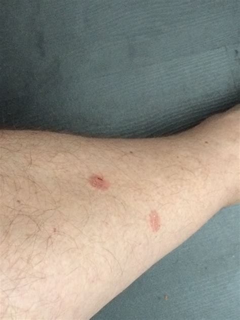 Red Spot On Leg Disappears When Pressed Lwmups