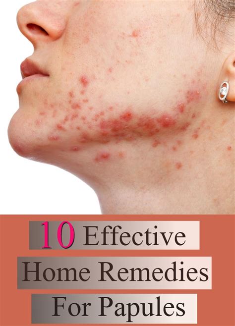 10 Effective Home Remedies For Papules Search Home Remedy