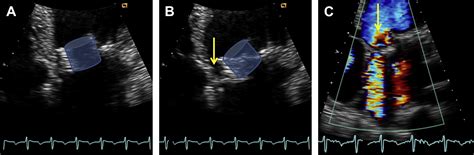 Mitral Prosthetic Valve Assessment By Echocardiographic Guidelines