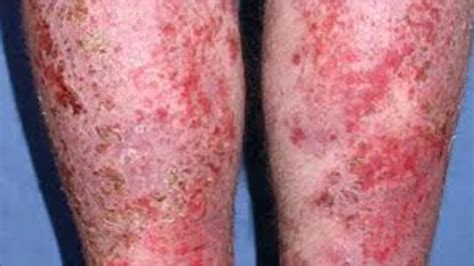 Eczema Treatment Eczema Skin Disease Youtube