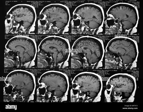 Ct Scans Of Human Head Stock Photo Alamy