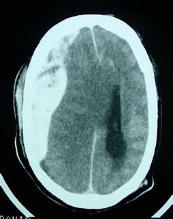 Radiologyspirit Acute Subdural Hematoma Gallery