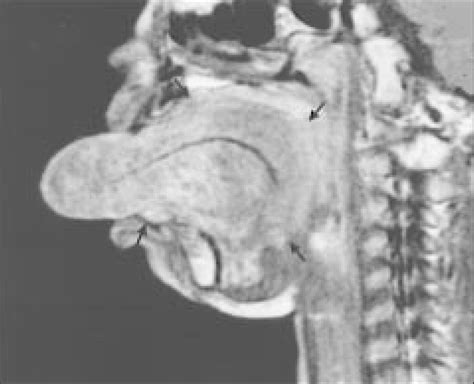 Magnetic Resonance Image Shows That The Lymphangioma Is Localized