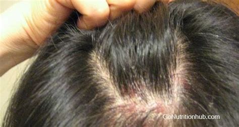 54 Cool Pimples On Scalp After Haircut Haircut Trends