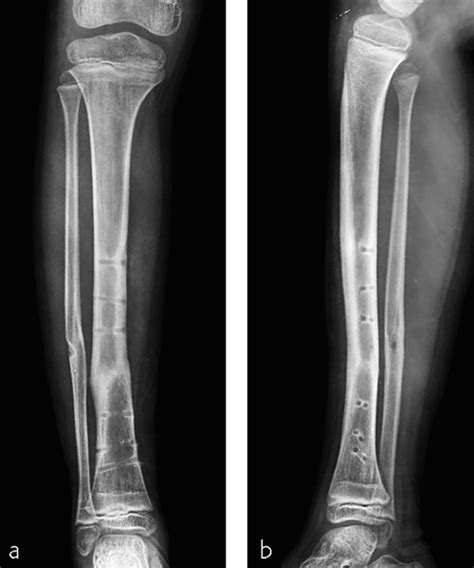 Tibia And Fibula Shaft Simple Fracture Oblique Musculoskeletal Key